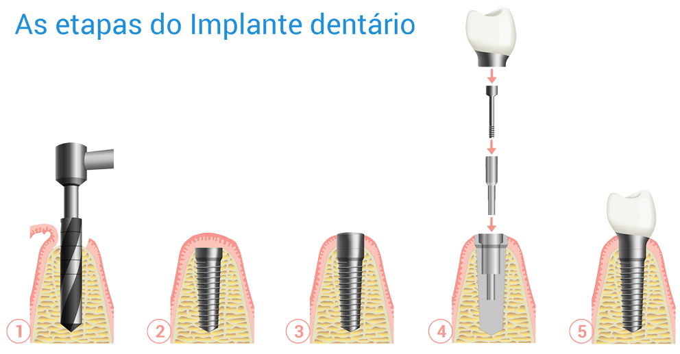 Como é feito um implante dentario