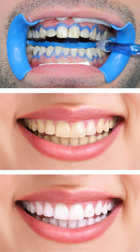 procedimentos no clareamento dental