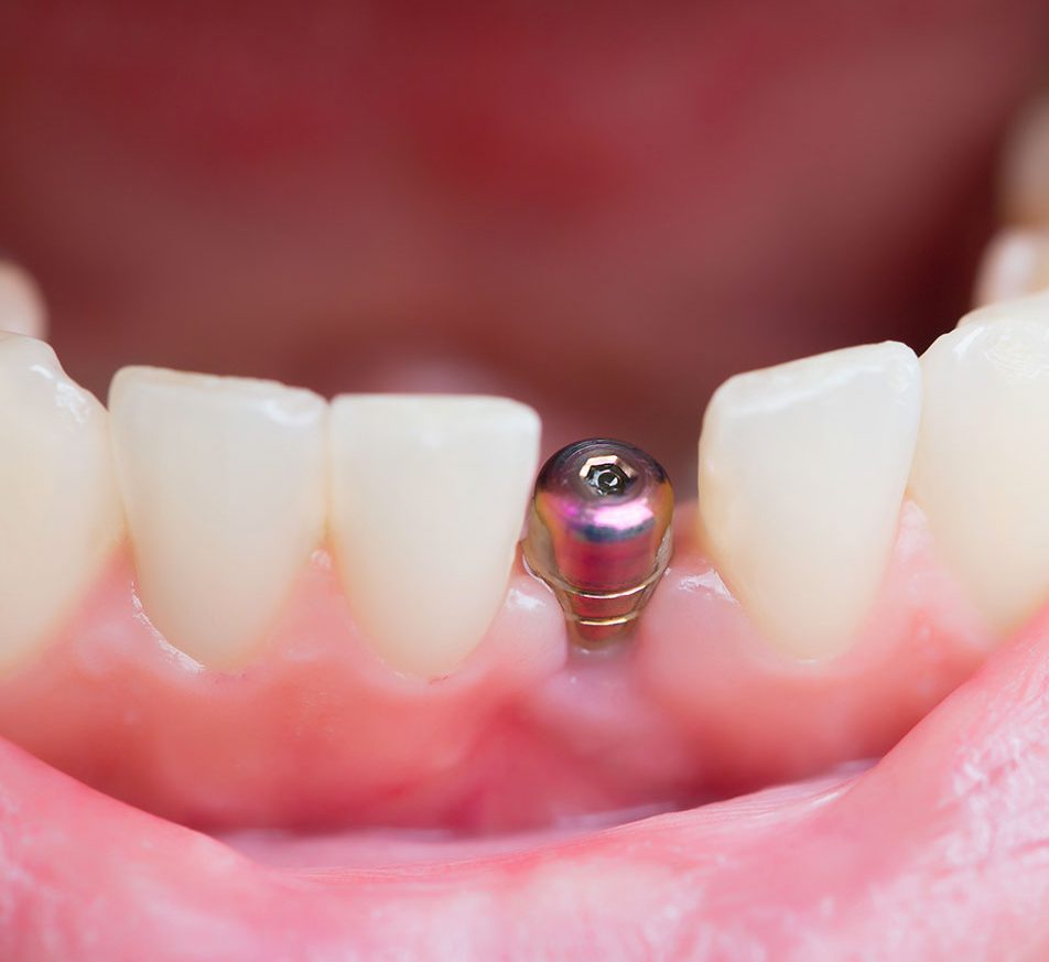 foto de um implante dentario sem a prótese